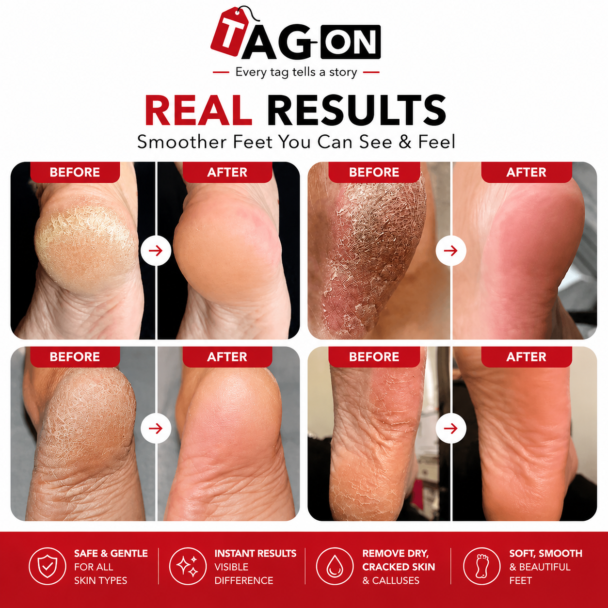 Tag On Callus Remover  (FREE Delivery 🎁)